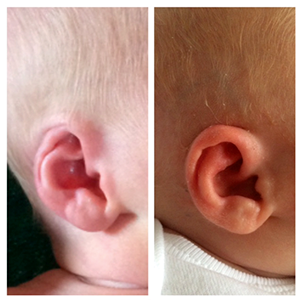How to: Neonatal Ear Molding - ENTtoday