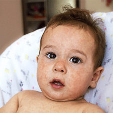 Different Types of Common Childhood Rashes - Washington Parent
